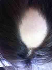 ALOPECIA AREATA