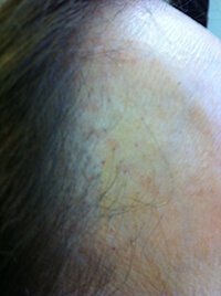 FRONTAL FIBROSING ALOPECIA