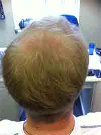 MALE PATTERN ALOPECIA